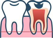 虫歯治療C1,C2